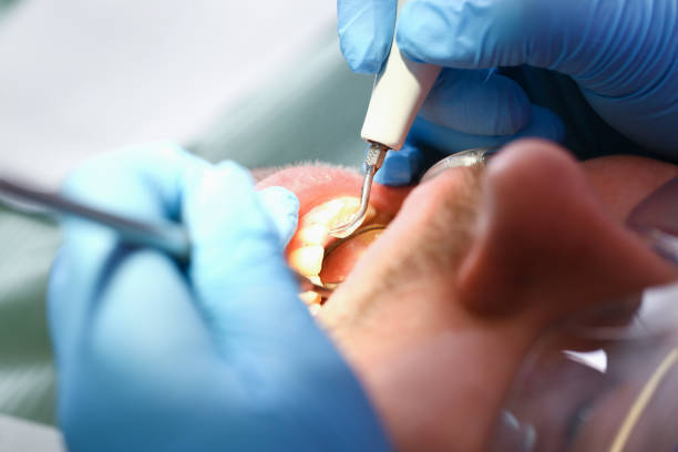 Best Emergency Treatment for Dental Infections or Abscesses in Arroyo Grande, CA